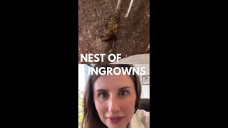 Huge Nest of Ingrown Hair [upl. by Asilak30]