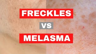 WHAT IS THE DIFFERENCE BETWEEN FRECKLES AND MELASMA [upl. by Enyr]