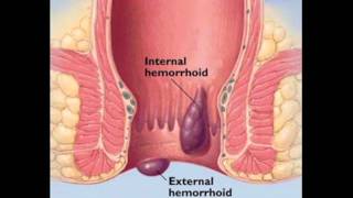 Hemorrhoids Treatment [upl. by Ititrefen663]