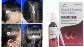 HERCIN PLUS Topical Solution Minoxidil amp Finasteride Topical Solution [upl. by Tessler]