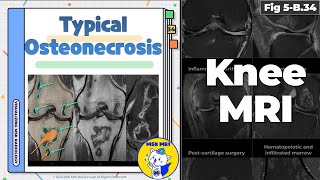 Fig 5B34 Typical Osteonecrosis [upl. by Nedyah255]