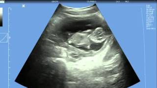 Echografie hart foetus met de Echomaster Flex USB [upl. by Duval]