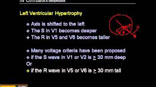 1215 Lead ECG Ventricular Hypertrophy [upl. by Postman833]