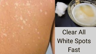 Apply This On Skin to Clear WHITE SPOTS  WHITE PATCHES VITILIGO  CREAM REACTION [upl. by Llerdna]