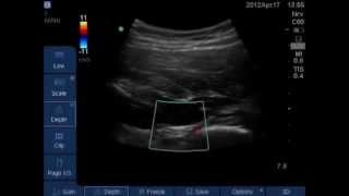 ultrasound guided parascral sciatic nerve block [upl. by Enelram]