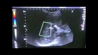 GB MASS with STENT in CBD and PNEUMOBILIA [upl. by Netsirk]