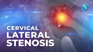 What is Cervical Lateral Stenosis  Foraminal Stenosis [upl. by Fannie]