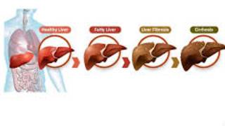 Beware of the inevitable fate of fatty liver fibrosis  cirrhosis esophageal varices  hepatoma [upl. by Driskill]