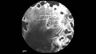 RealTime Fluorescein Angiography [upl. by Otaner]