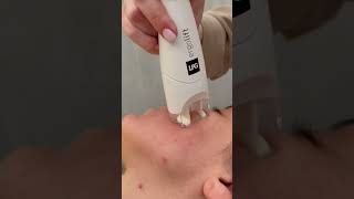 LPG Facial london skincare [upl. by Berkeley]