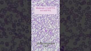 Eosinophils morpholoyEosinophilia causes and degrees laboratory microscope hematology [upl. by Nosemaj]