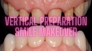 VERTICAL PREPARATION full case Zirconia crowns [upl. by Ayaj957]