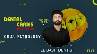 dental caries  part 3  oral pathology  عزت شومان [upl. by Sashenka245]