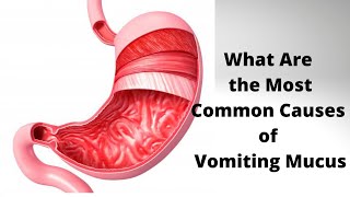 What Are the Most Common Causes of Vomiting Mucus [upl. by Gussi]