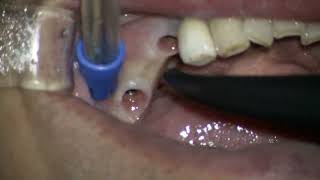 Straumann 2 BLT final set in posterior mandible [upl. by Sema32]