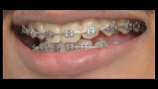 braces time lapse orthodontic treatment [upl. by Leinehtan]