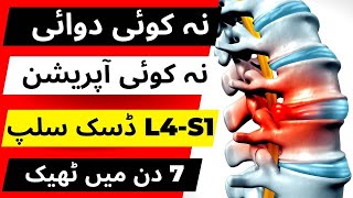 L5S1 Disc Herniation Treatment  No Surgery Needed Anymore discherniation [upl. by Josi]