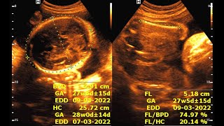 Sonographic evaluation at 37 weeks of pregnancy [upl. by Masson]