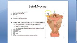 Pathology 721 a Leiomyoma FIBROID uterus fibromyoma Smooth muscle benign Gross specimen Practical [upl. by Harraf]