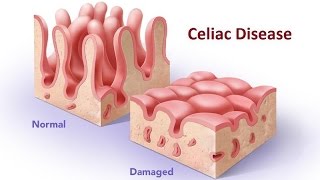 Celiac Disease [upl. by Trust]