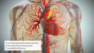 Progression av aortastenos [upl. by Mischa555]