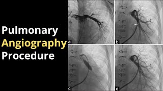 Pulmonary Angiography Procedure Angiogram Balloon Video [upl. by Aeslek647]