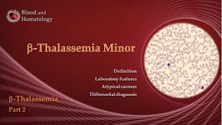 BetaThalassemia part 2  BetaThalassemia Minor [upl. by Asserat760]