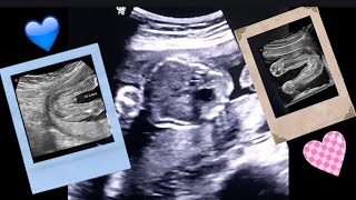 When can you see gender on ultrasound  How to tell gender on ultrasound  Pregnancy Ultrasound [upl. by Anemix428]