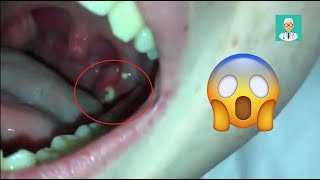 How To Remove Tonsil Stones [upl. by Ellmyer]