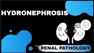 HYDRONEPHROSIS  Renal pathology   Med Bees [upl. by Ellehsim]