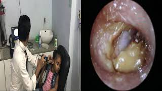 Best ear wax removal ever  How to remove earwax  EXTRA large ear wax in small child [upl. by Gussman]