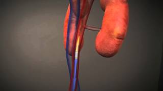 Transfemoral Animation [upl. by Nosraep]