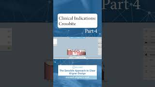 Clinical Indications Crossbite Part 4 [upl. by Pierre]