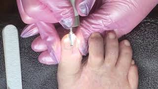 Toenail reconstruction on damaged nail [upl. by Prue]