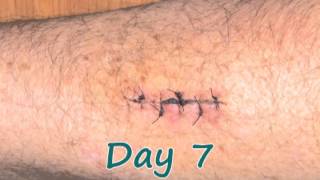 Time Lapse Recovery from Forearm Surgery [upl. by Leeanne]