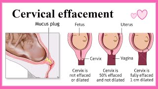 cervical effacement [upl. by Annairda]