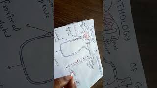 pathogenesis of glomerulonephritis NGMedicals [upl. by Ramak]