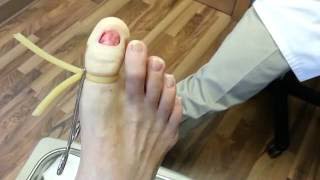 Permanent toenail removal in less than 4 minutes [upl. by Kylie]