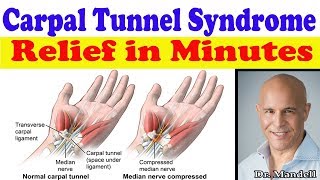 Carpal Tunnel Syndrome Fast Natural Relief in Minutes  Dr Alan Mandell DC [upl. by Caritta552]