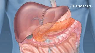 Pancreatic Auto Islet Transplantation with Total Pancreatectomy [upl. by Koerlin]