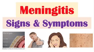 Meningitis Signs and Symptoms amp Why They Occur [upl. by Radnaxela]