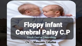 Cerebral Palsy  Floppy infant  Neurology  Pediatrics [upl. by Nylsirhc]