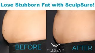 Dianas SculpSure Journey  SHOCKING Before amp After [upl. by Nahtanod]