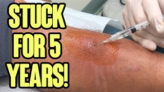 Leg Double Feature  Infected Leg and Amazing Toothpick Splinter Removal [upl. by Naresh]