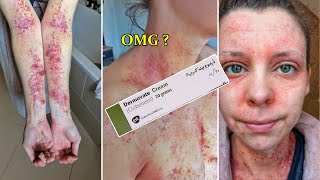 Dermovate Cream Review in English  Skin Lightening Eczema Fungus amp Pigmentation Solutions [upl. by Oihsoy786]