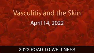 Vasculitis and the Skin [upl. by Quennie]