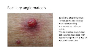 Bacillary angiomatosis [upl. by Slemmer]