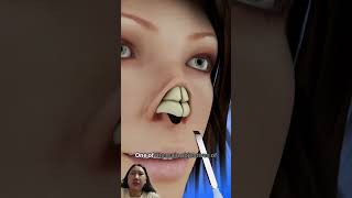 Main nasal bone correctionanimation doctor shortsvideo medicalanimation beauty [upl. by Yule920]