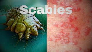 SCABIES Causes Signs and Symptoms What Diagnosis and Treatment to do  SCABIES  RD LifeStyle Vlogs [upl. by Kehr]