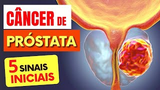 5 SINAIS de Alerta para CÂNCER de PRÓSTATA que Todos Deveriam Saber [upl. by Aicnetroh]